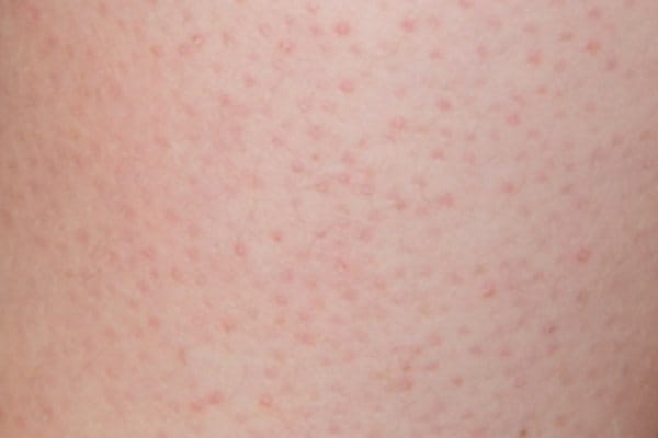 Keratosis Pilaris Causes Symptoms And Treatment Eucerin